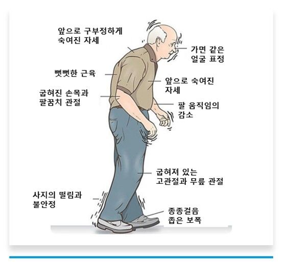 파킨슨병의 증상