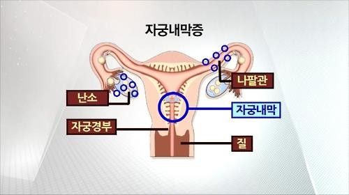 자궁내막증