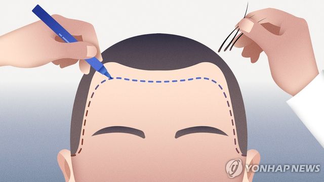 남성 모발이식 (PG)