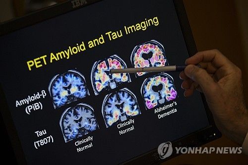 알츠하이머병 연구자료 