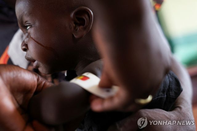 영양실조 치료받는 어린이