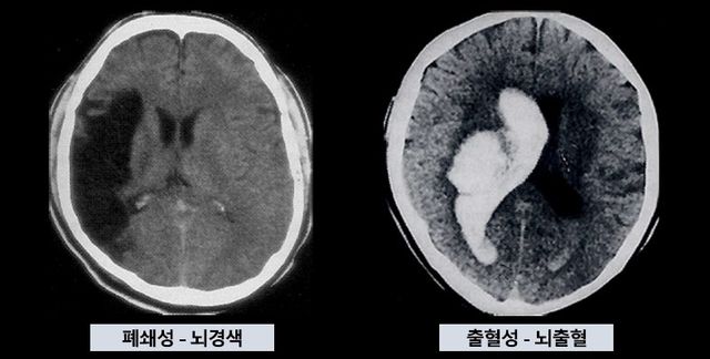 뇌경색과 뇌출혈