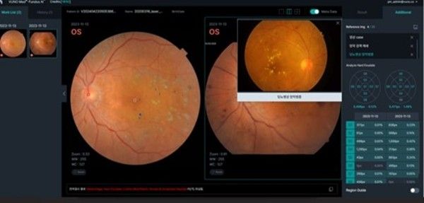VUNO Med®-Fundus AI