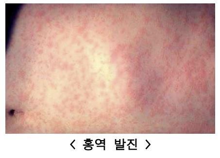 (서울=연합뉴스) 홍역 발진. 미국질병관리본부(Centers for Disease Control and Prevention) 사진을 질병관리청에서 재가공한 사진. 2025.05.07. [질병관리청 제공. 재판매 및 DB 금지]