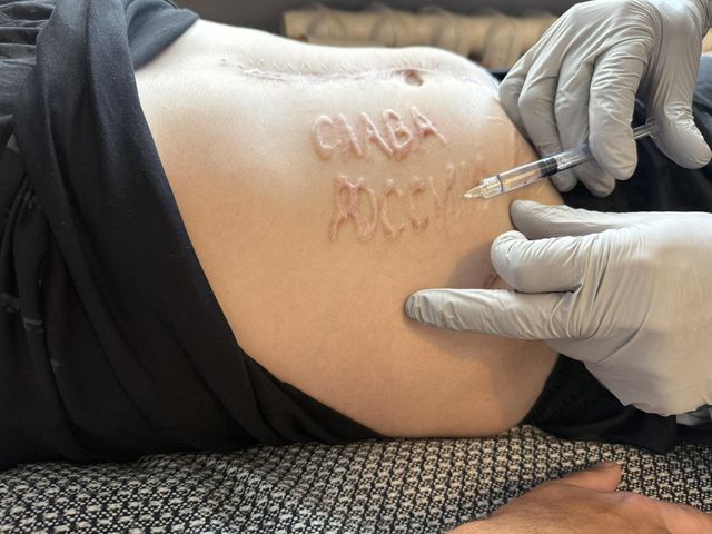 러시아에 포로로 잡혔던 우크라 군인의 배에 새겨진 '러시아에 영광을'