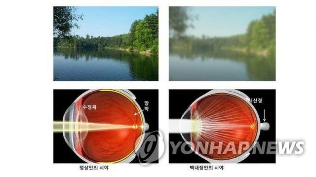 정상 눈과 백내장 눈의 시야 비교
