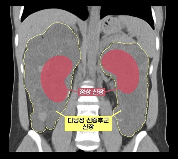 실제 다낭성 신증후군 환자의 신장과 정상 신장 비교