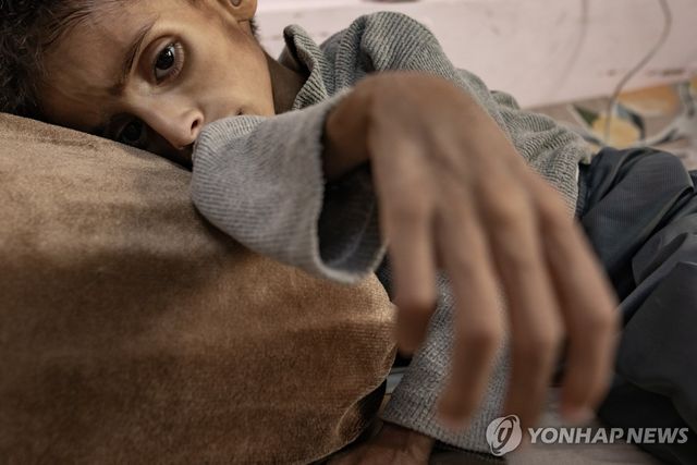 지난달 26일(현지시간) 영양실조로 가자지구 남부 칸 유니스의 나세르 병원에서 치료받는 5세 아동