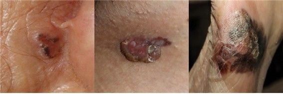 왼쪽부터 기저세포암, 편평세포암, 악성흑색종