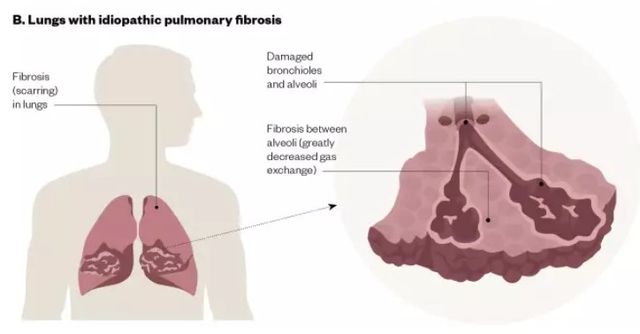 희귀 폐질환자 '숨통' 트일까…신약 타이바소 보험급여 여부 주목 - 1