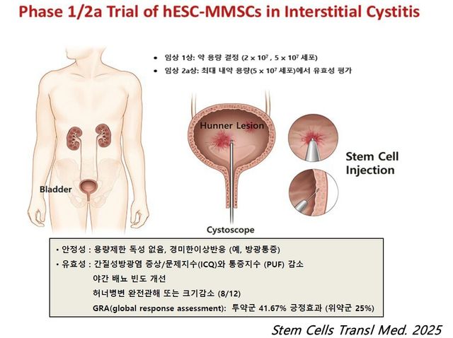 난치병 간질성방광염 세포치료 모식도