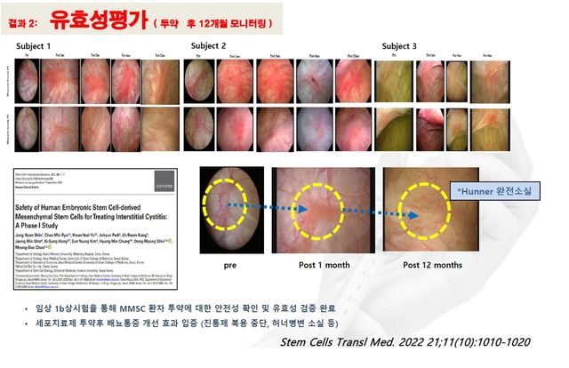 배뇨장애 세포치료 12개월 경과 모습