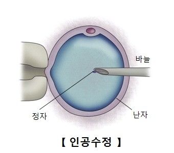 체외 수정