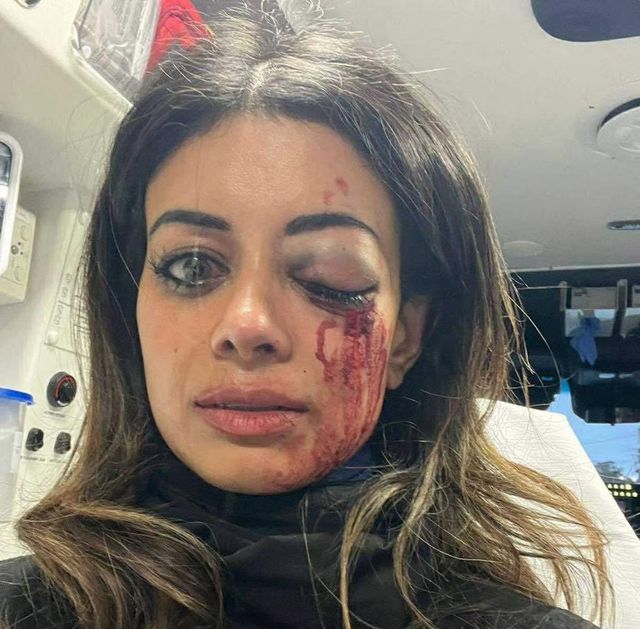 팔레스타인 지지 시위 중 다친 호주 정치인 해나 토머스