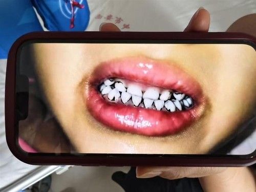 '중국 유치원 납중독' 치아 일부가 검게 변한 유치원생