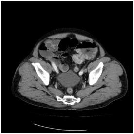 대장암으로 장폐쇄가 생겨서 유발된 변비