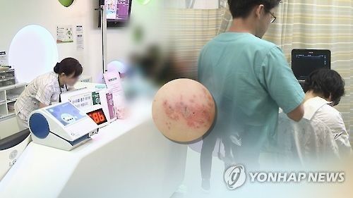 헤르페스 바이러스(HSV)에 의한 대상포진(CG)
