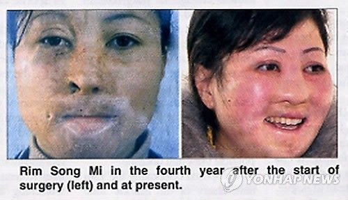 북한 여성 노동자의 성형수술 전후 사진