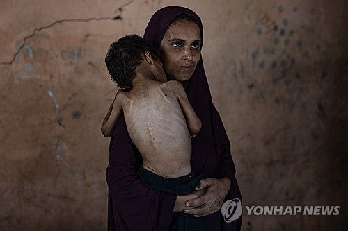 심각한 영양실조 상태인 두살배기 아이를 안고 있는 여성 
