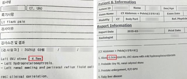 급여 삭감된 요로결석 환자들의 결석 크기 판독 기록