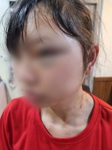 상해 피해를 입은 B씨