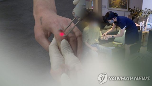 문신 제거 시술(CG)