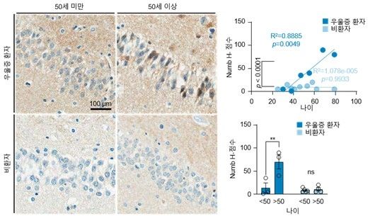 우울증 환자의 사후 뇌 조직 연령별 비교 
