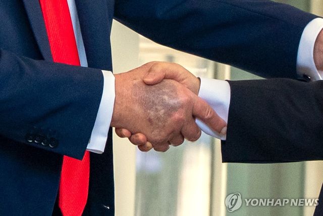 25일(현지시간) 백악관에서 이재명 대통령과 악수하는 도널드 트럼프 미국 대통령(왼쪽)의 오른손 손등에 멍으로 보이는 검푸른 자국이 포착됐다.[AP=연합뉴스. 재판매 및 DB 금지]