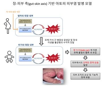 이번 연구에서 제시한 아토피 피부염 발병 모델