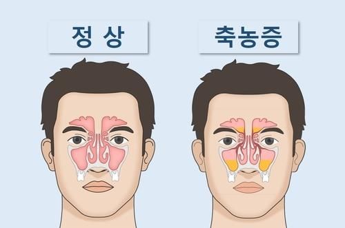 만성 부비동염-부비동에 고름