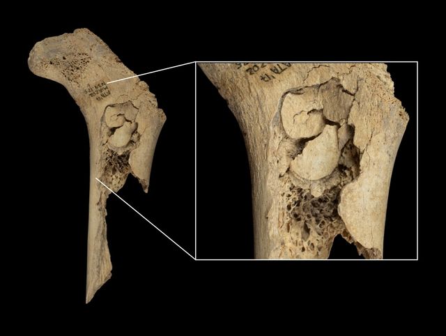 뼈를 깨 골수를 추출한 흔적이 있는 유아 대퇴골 