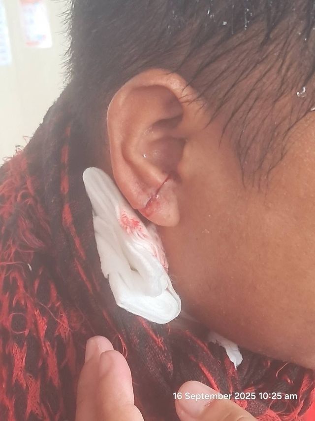 중국 측 물대포에 의해 부상을 입었다고 주장한 필리핀 인원