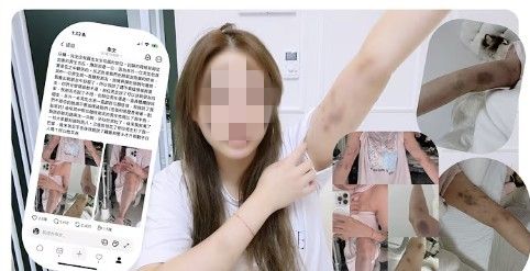 폭행당해 멍든 신체를 공개하는 대만 유튜버