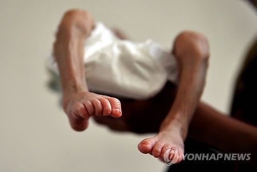 영양실조에 걸린 아기