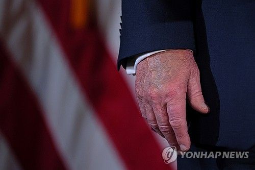 멍 자국 난 트럼프 대통령의 손