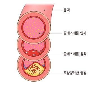 고지혈증