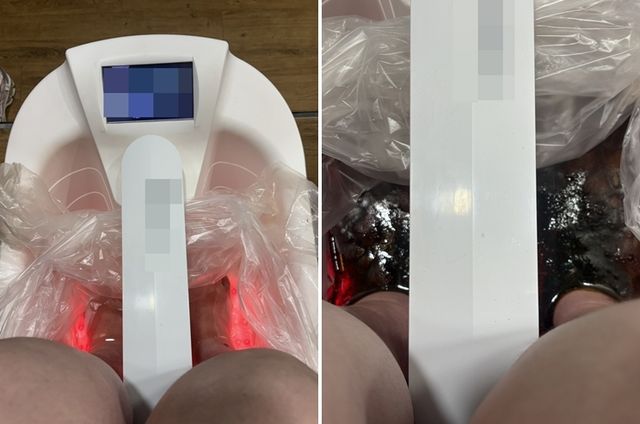 족욕 전 물(왼쪽)과 1시간 뒤 검게 변한 물(오른쪽)
