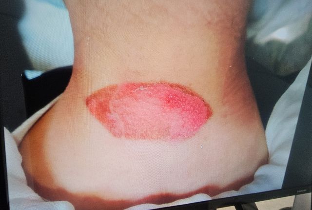 화상 입은 근로자