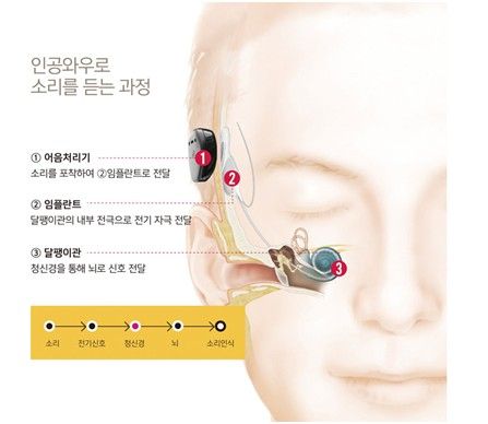 [호주 청각전문기업 코클리어 제공]