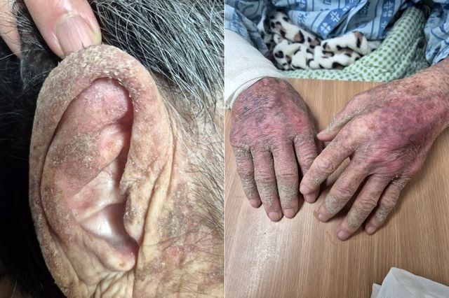 옴 감염으로 피부 상태가 심하게 악화된 모습