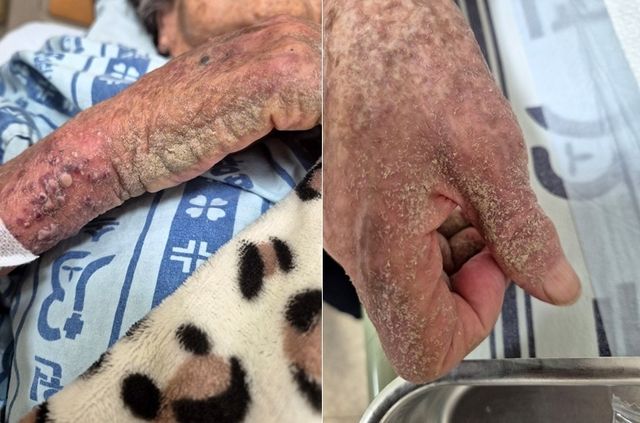 옴 감염으로 피부 상태가 심하게 악화한 모습