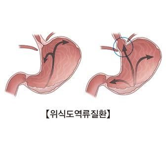 위-식도 역류