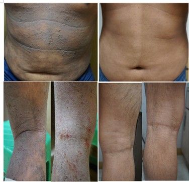 중증아토피피부염환자의 치료 전(왼쪽)과 치료 후(오른쪽) 모습 