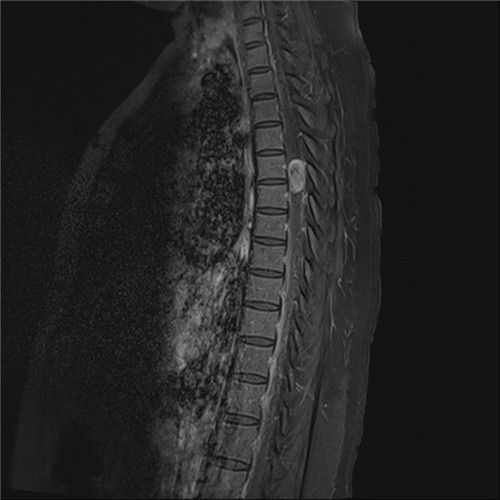수술 전 척수종양 MRI