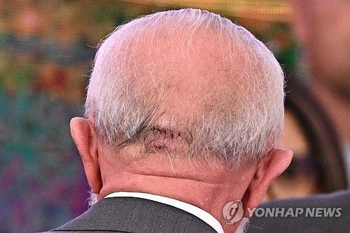 두개골 절제술 수술