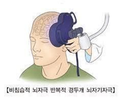 경두개 자기자극
