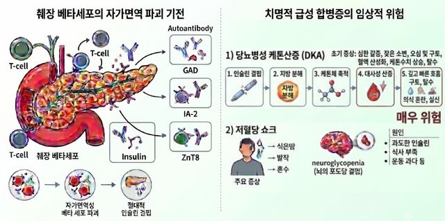 1형 당뇨병의 발생과 급성 합병증