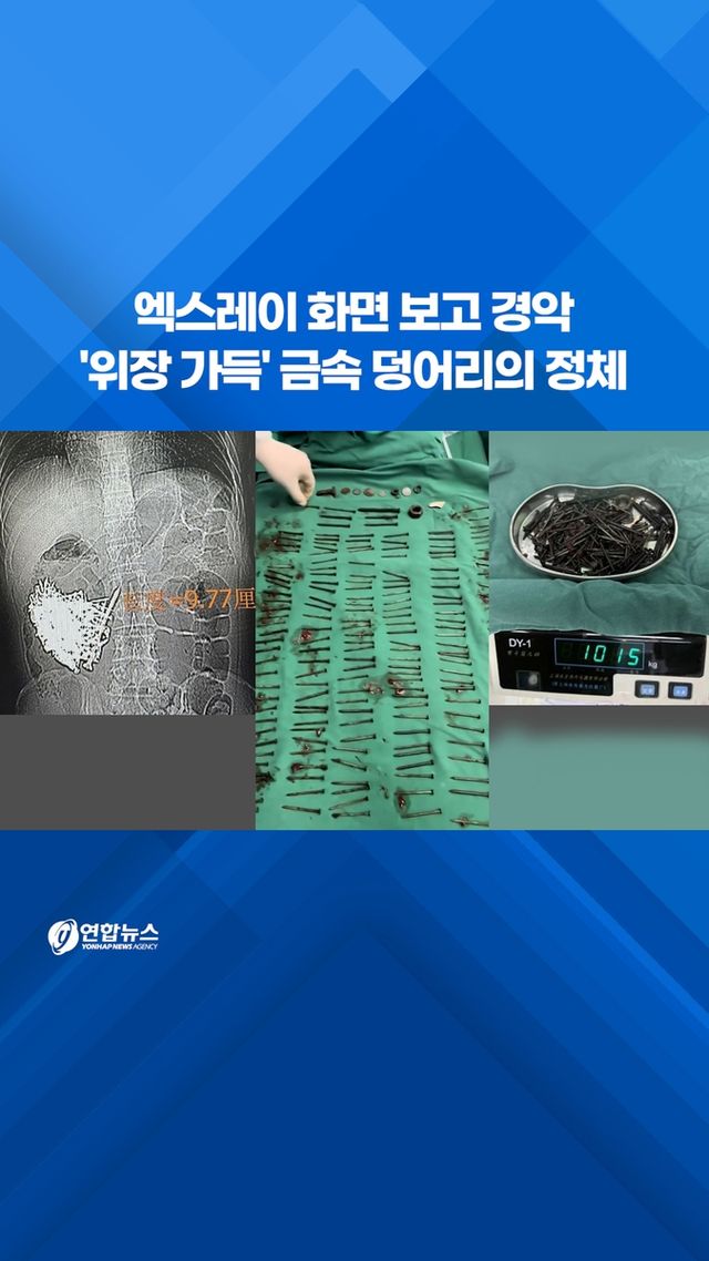 [쇼츠] 엑스레이 화면 보고 경악…中 남성 뱃속 금속의 정체 - 2