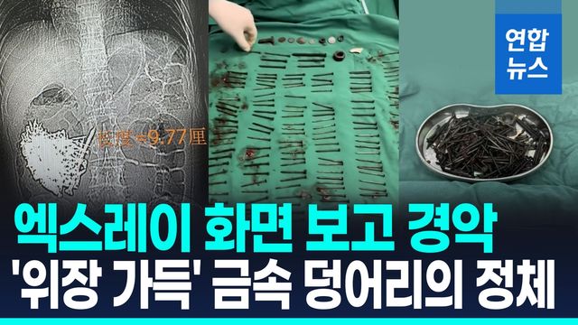 [영상] 위장서 꺼낸 금속만 1kg… 中 남성 뱃속 '180개 못'의 정체 - 2