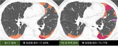 (서울=연합뉴스) 사진은 AI 기반 CT 정량 분석 기술로 섬유화가 진행된 폐 영역을 인식해 75세 남성 특발성 폐섬유증 환자의 1년간 폐 섬유화 진행 정도를 비교한 모습. 첫 검사 당시 폐 섬유화 점수는 11.66%이었으나 1년 뒤 추적 검사에서 15.77%로 증가했다. 망상 음영(주황색)은 9.34%에서 11.39%로, 벌집 모양 음영(분홍색)은 2.32%에서 4.38%로 늘었다. 2026.08.03. [서울아산병원 제공. 재판매 및 DB 금지]